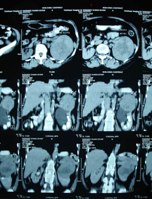Left renal cell carcinoma