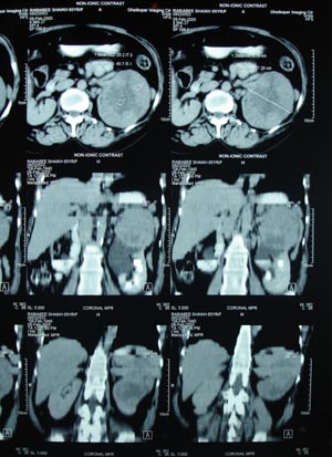 Renal cell carcinoma 2