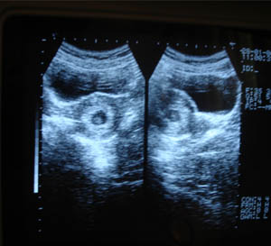 1st trimester obstetric ultrasonography