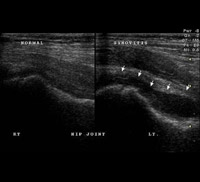 Hip Synovitis