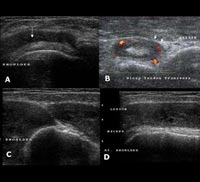 Rheumatoid arthritis