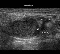 Soft tissue nerve sheath tumor