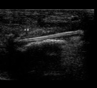 Wooden stick, embedded in forearm