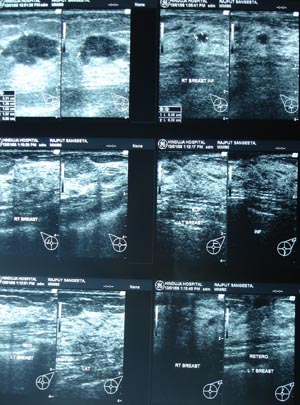 Ultrasonography of breast