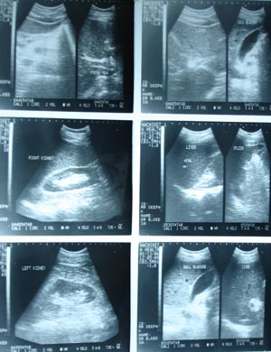 Ultrasonography whole abdomen