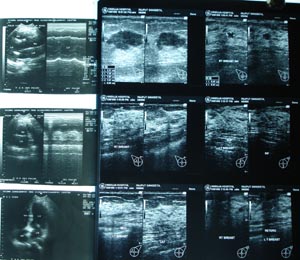 USG.Breast
