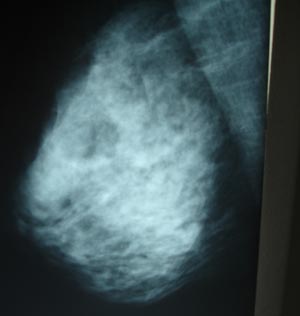 Mammography 1