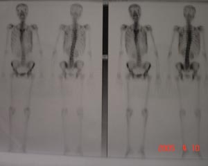 Bone scan