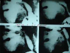 Barium ilieocaecal region