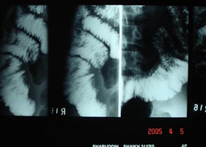 Barium follow through