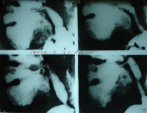 Barium ilieocaecal junction