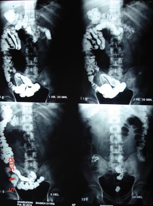 Barium meal with follow through