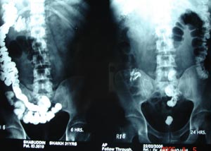 Barium sulfate as contrast media