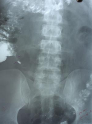 Barium visualizing appendix