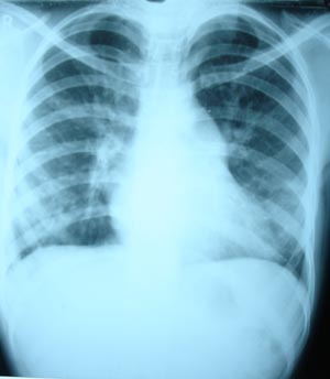 Bilateral congestion with mitral stenosis