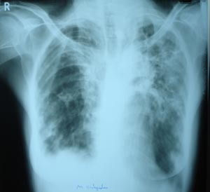 Bilateral extensive fibrosis