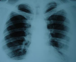 Bilateral pleural effusion