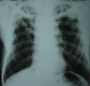 Bilateral pulmonary tuberculosis
