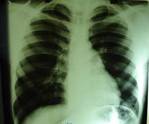 Chest Xray Normal