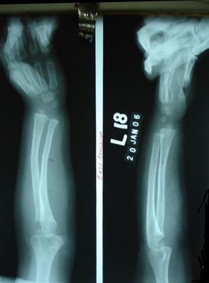 Colles' fracture 1