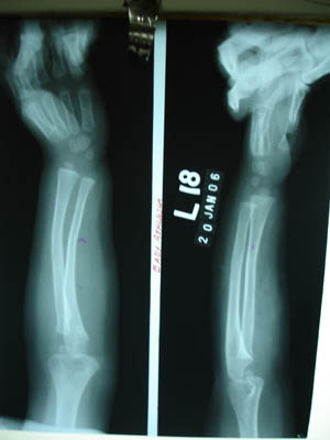 Colles' fracture 2