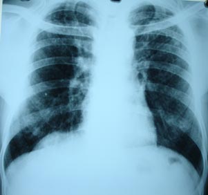 Elevated Dome of diaphragm 