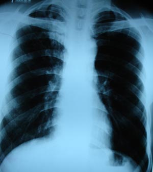Emphysema