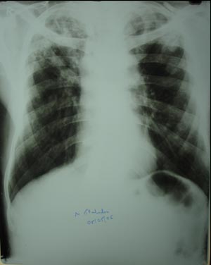 Extensive pulm.koch's infection