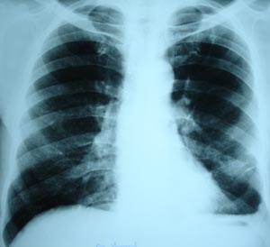 Flattening of dome of diaphragm
