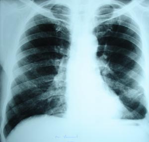 Flattening of left dome of diaphragm