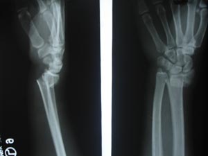 Fracture forearm