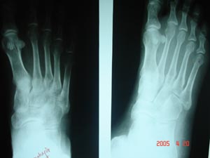 Fracture metatarsal