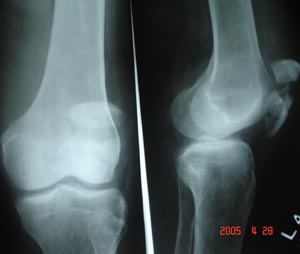 Fracture patella