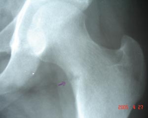 Hairline cortical fracture