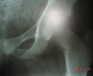 Hairline fracture femur neck