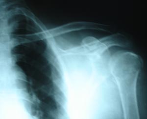 Humerus fracture