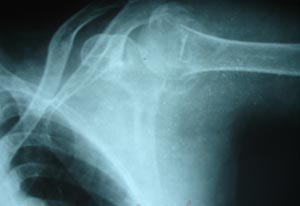 Humerus neck fracture