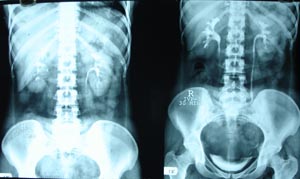 Intravenous pyelography