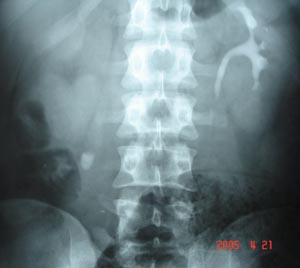 Intravenous Urography