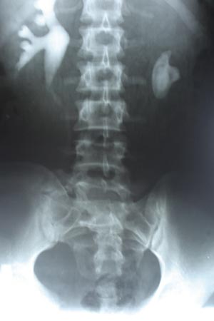 IVP staghorn calculas