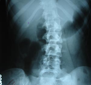 KUB & radio opaque calculas