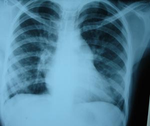 Left Atrial hypertrophy with mitral stenosis