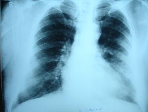 Left lower lobe pneumonia