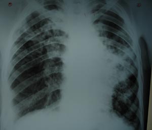 Left mid zone opacity