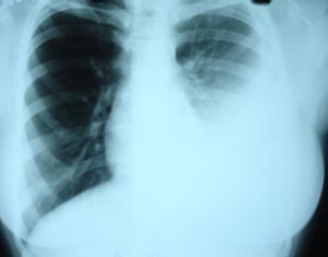 Left pleural effusion1