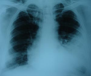 Left pleural effusion2