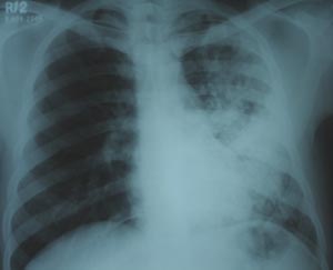 Left mid zone Koch's infection 1