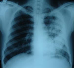 Left mid zone Koch's infection 2