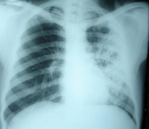 Left mid zone Koch's infection 3