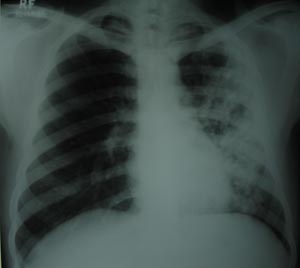 Left mid zone Koch's infection 4